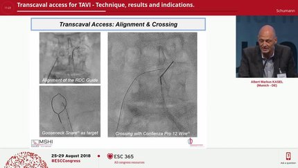 Transcaval access for TAVI - Technique, results and indications.