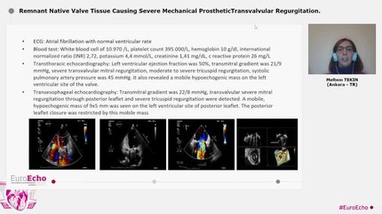 Remnant Native Valve Tissue Causing Severe Mechanical ProstheticTransvalvular Regurgitation.