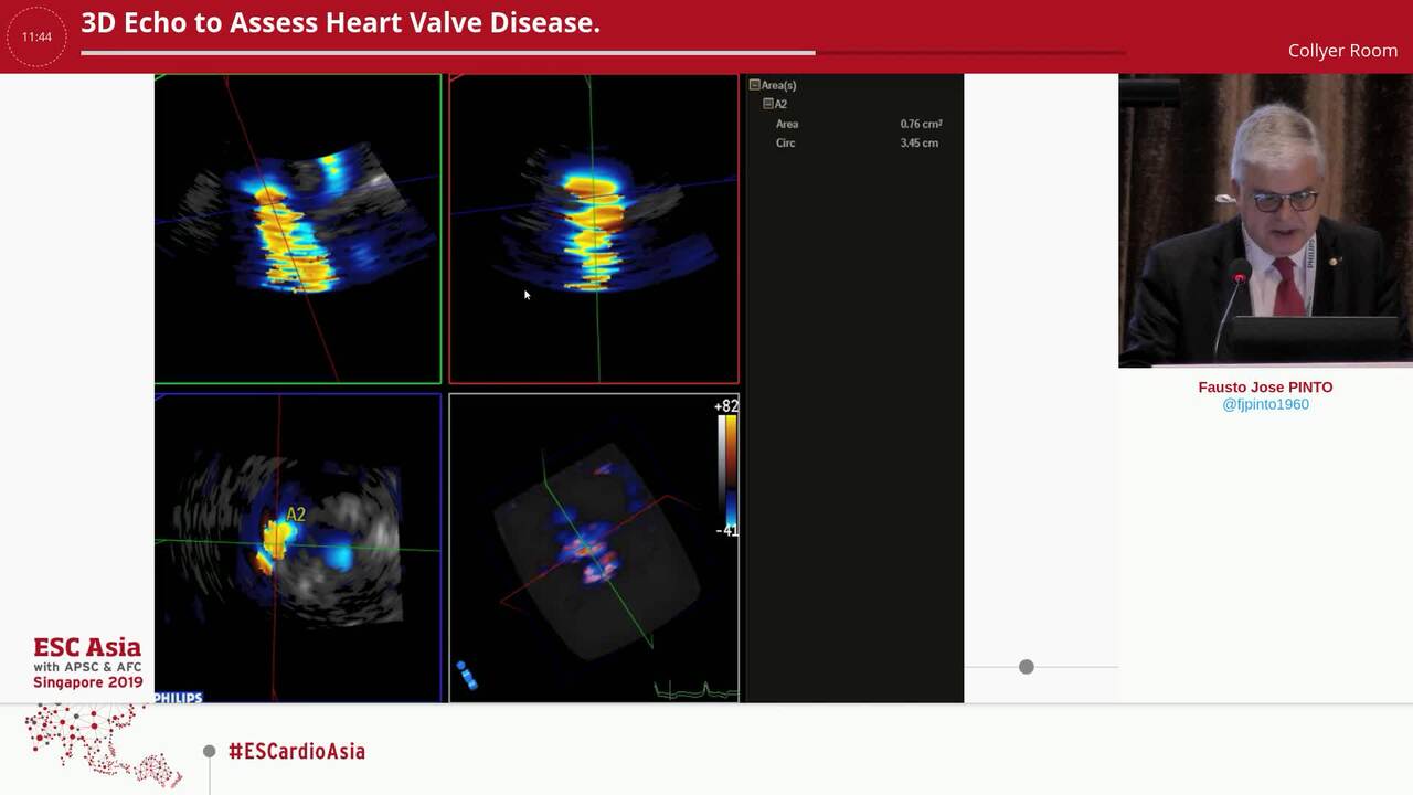 3D Echo to Assess Heart Valve Disease.