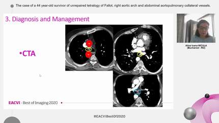 The case of a 44 year-old  survivor of unrepaired tetralogy of Fallot, right aortic arch and abdominal aortopulmonary collateral vessels.
