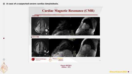 A case of a suspected severe cardiac Amyloidosis.