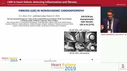 CMR in heart failure: detecting inflammation and fibrosis.