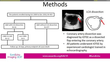 The value of left coronary artery dissection concomitant with Stanford A type acute aortic dissection diagnosed by intraoperative transesophageal echocardiography