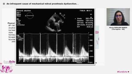 An infrequent cause of mechanical mitral prosthesis dysfunction.
.