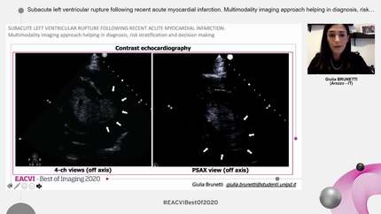 Subacute left ventricular rupture following recent acute myocardial infarction. Multimodality imaging approach helping in diagnosis, risk stratification and decision making.