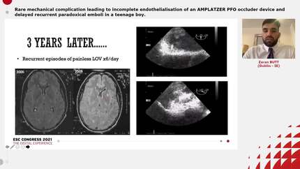 Rare mechanical complication leading to incomplete endothelialisation of an AMPLATZER PFO occluder device and delayed recurrent paradoxical emboli in a teenage boy.