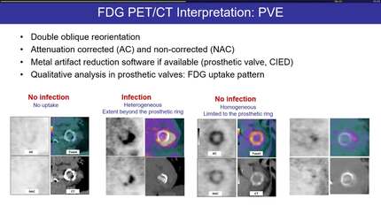 Cardiac infection