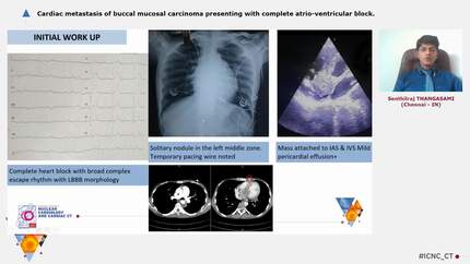 Cardiac metastasis of buccal mucosal carcinoma presenting with complete atrio-ventricular block.