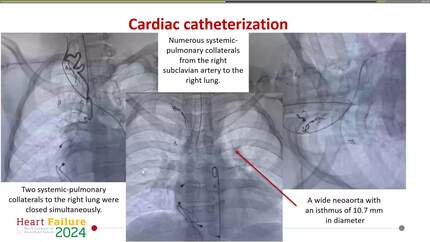 Can hemoptysis in a young patient with hypoplastic left heart syndrome indicate developing heart failure?