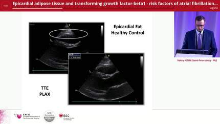 Epicardial adipose tissue and transforming growth factor-beta1 - risk factors of atrial fibrillation in patients with metabolic syndrome.