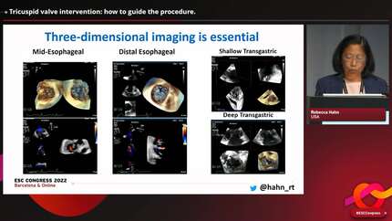 Imaging to guide transcatheter intervention in tricuspid regurgitation