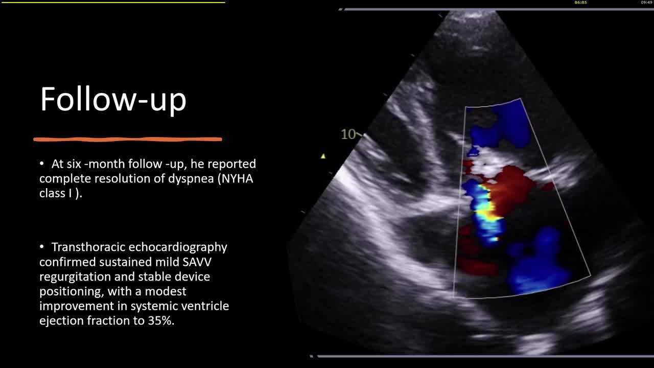 Systemic atrioventricular valve transcatheter edge-to-edge repair in congenitally corrected transposition of the great arteries and dextrocardia