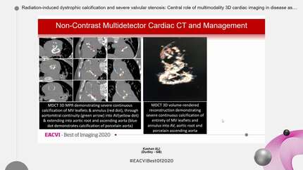 Radiation-induced dystrophic calcification and severe valvular stenosis: Central role of multimodality 3D cardiac imaging in disease assessment and planning of combined transcatheter aortic and mitral valve replacement.