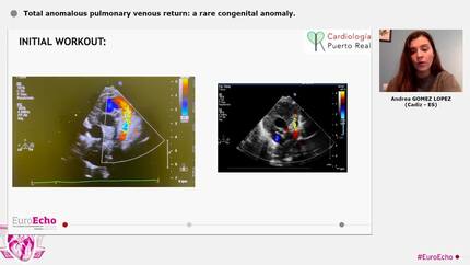 Total anomalous pulmonary  venous return: a rare congenital anomaly.