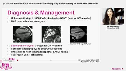 A case of hypokinetic non-dilated cardiomyopathy masquerading as submitral aneurysm.