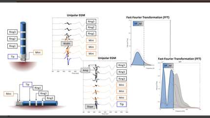Influence of tissue-electrode distance on unipolar and bipolar voltage for large-tip, ring-, and mini-electrodes 