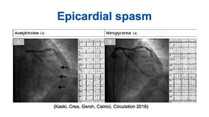 Why we should not settle for 'ongoing angina', how some hospitals lead by example.