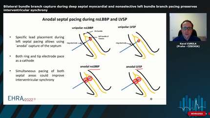 Bilateral bundle branch capture during deep septal myocardial and nonselective left bundle branch pacing preserves interventricular synchrony