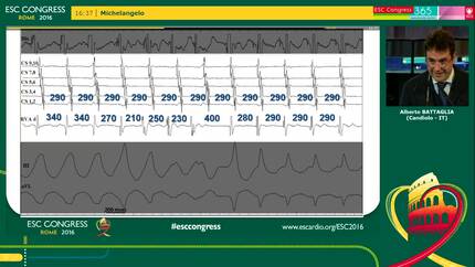 A rare case of atrioventricular nodal re-entry tachycardia triggered by ventricular tachycardia