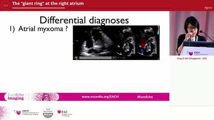 The "giant ring" at the right atrium