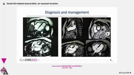 Covid 19-related myocarditis: an unusual location.