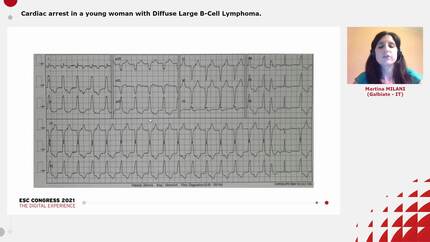Cardiac arrest in a young woman with Diffuse Large B-Cell Lymphoma.
