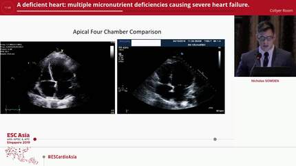 A deficient heart: multiple micronutrient deficiencies causing severe heart failure.