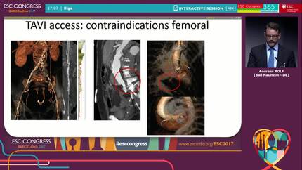 CT to guide patient selection before TAVI.