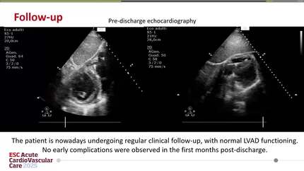 Bridge over troubled water: prolonged intra-aortic balloon pump support to improve right ventricular function as bridge to LVAD candidacy