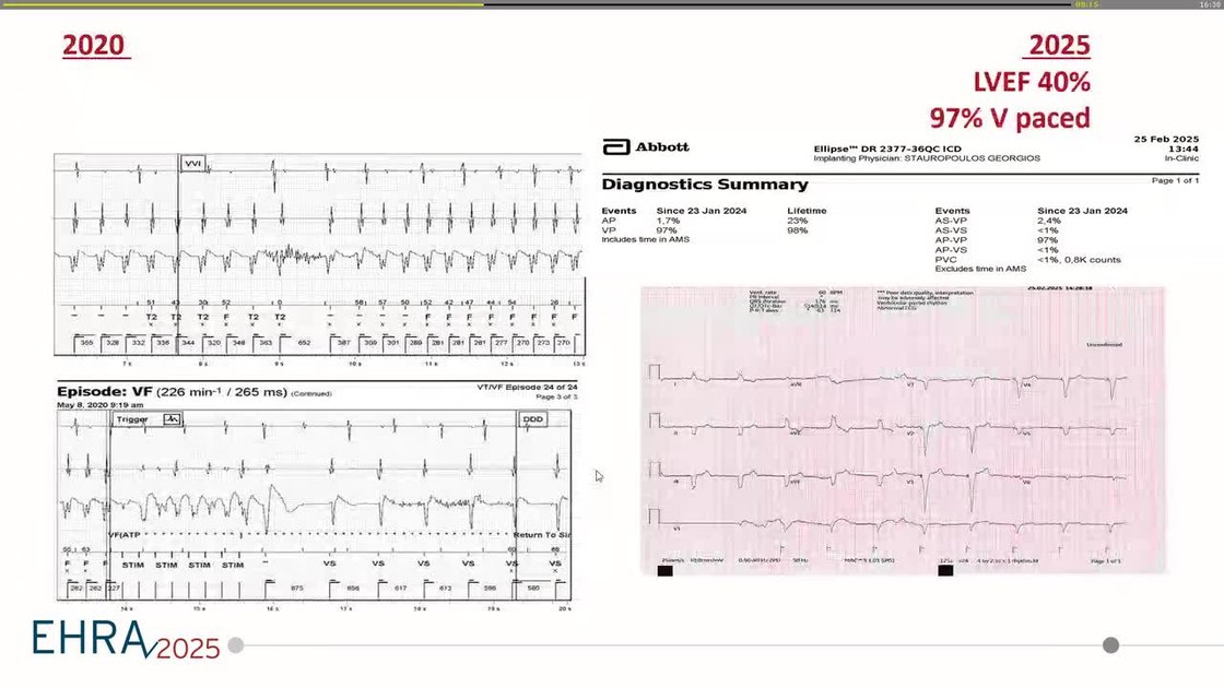 ESC 365 - Young female patient presenting with heart block. Diagnosis ...