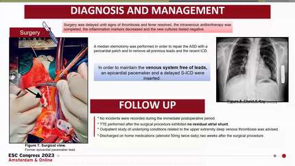 Iatrogenic atrial septal defect following percutaneous lead extraction. An unusual preventable  complication.