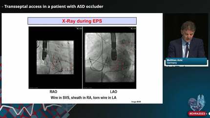How I managed my SVT ablation nightmare