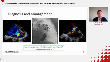 Simultaneous transcatheter pulmonary and tricuspid valve-in-ring implantation.