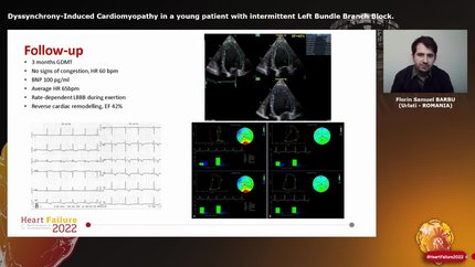 Dyssynchrony-Induced Cardiomyopathy in a young patient with intermittent Left Bundle Branch Block.