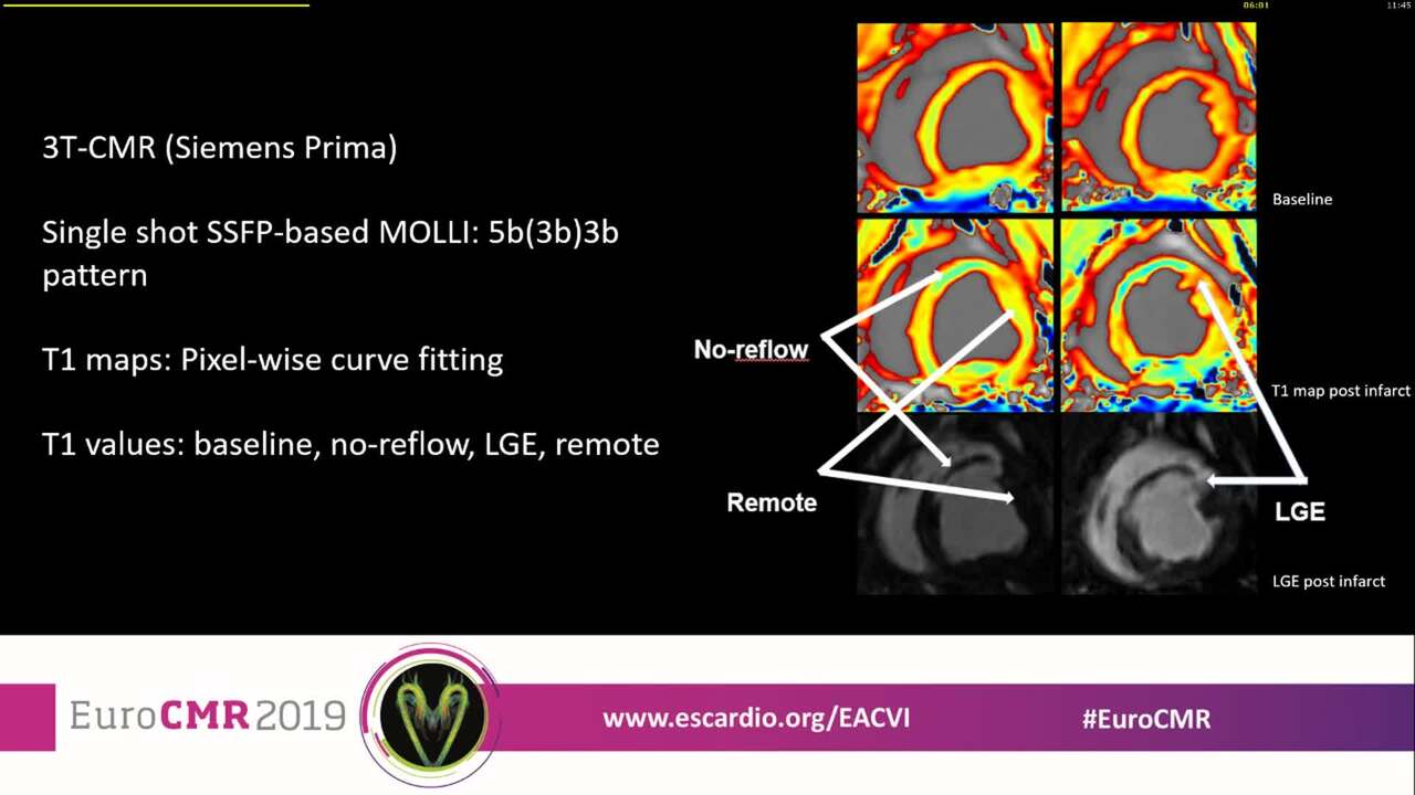 Native T1 mapping discriminates microvascular obstruction in the acute phase of reperfused STEMI