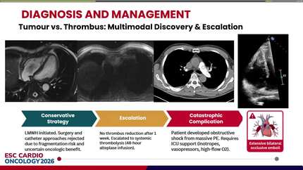 Sailing between tumor and thrombus: a multidisciplinary approach to a high-risk right atrial mass and pulmonary embolism