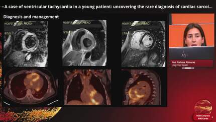 A case of ventricular tachycardia in a young patient: uncovering the rare diagnosis of cardiac sarcoidosis.