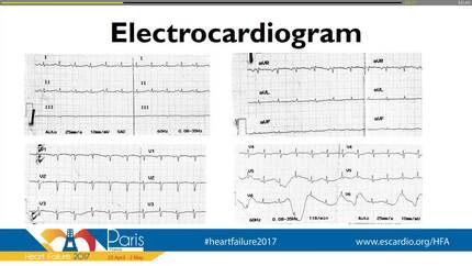 A patient with human immunodeficiency virus infection and acute decompensated heart failure; never forget the pericardium