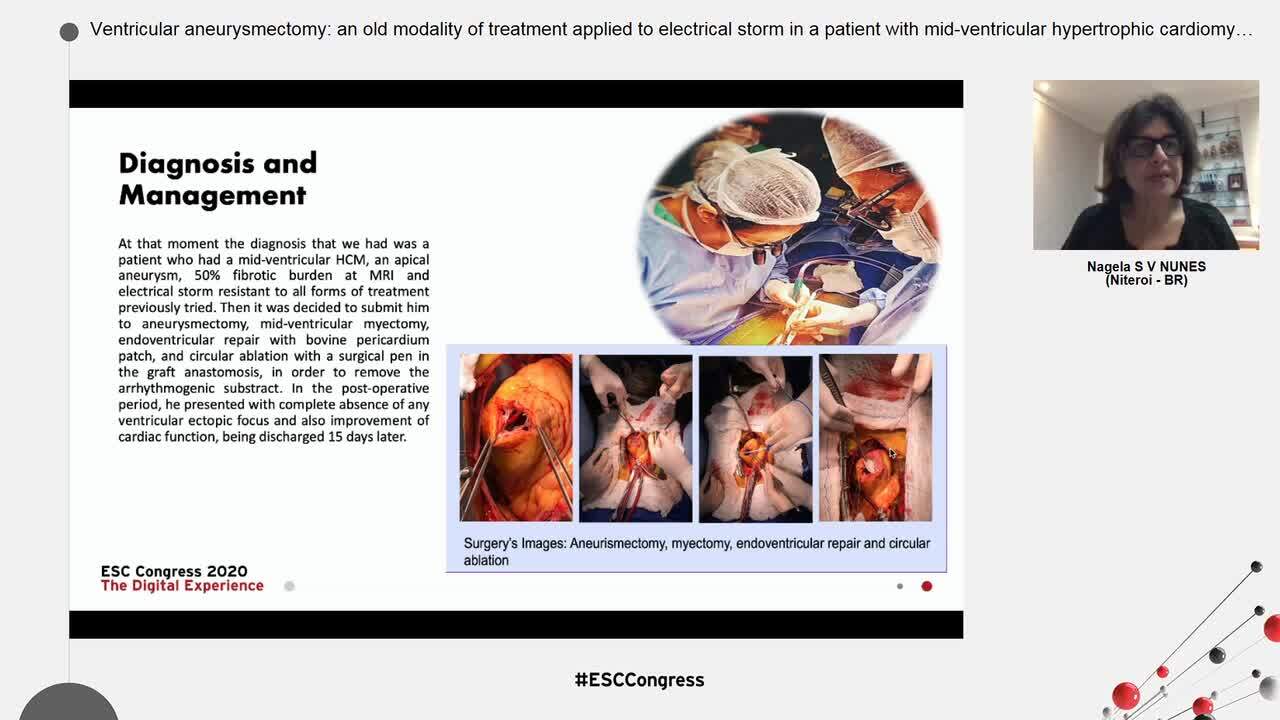 Ventricular aneurysmectomy: an old modality of treatment applied to electrical storm in a patient with mid-ventricular hypertrophic cardiomyopathy.