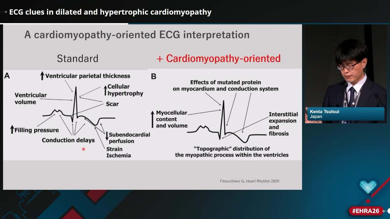 ECG clues in dilated and hypertrophic cardiomyopathy