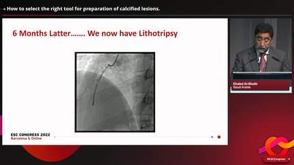 Paving the rocky road to success: percutaneous coronary intervention in calcified lesions