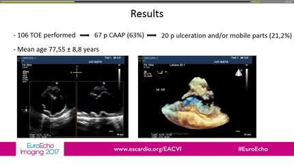 Prevalence, morphological characteristics and management of complicated atherosclerotic aortic plaques in acute ischemic stroke patients previously selected by echoscan. 