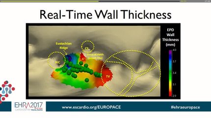 EPD - Real time tissue characterization during ablation