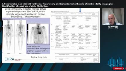 A hypertensive man with left ventricular hypertrophy and ischemic stroke:the role of multimodality imaging for identification of substrate of atrial fibrillation.