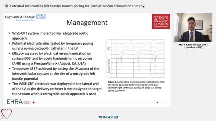 Potential for leadless left bundle branch pacing for cardiac resynchronisation therapy.