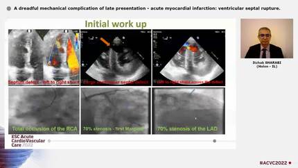 A dreadful mechanical complication of late presentation - acute myocardial infarction:  ventricular septal rupture.