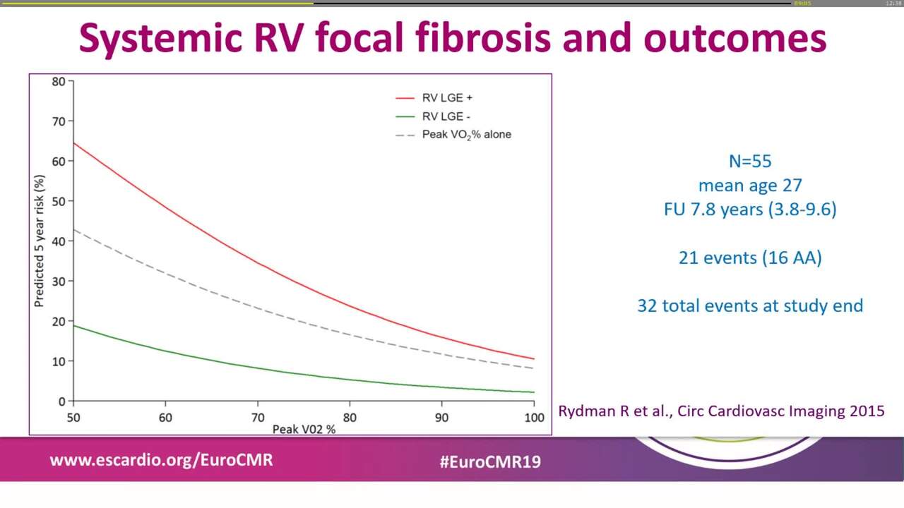 The systemic right ventricle.