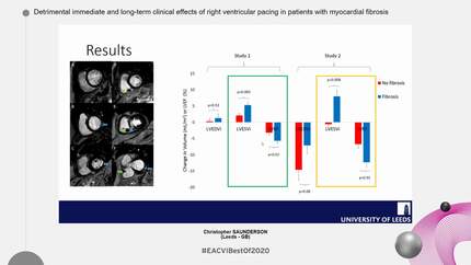 Detrimental immediate and long-term clinical effects of right ventricular pacing in patients with myocardial fibrosis 