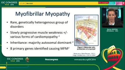 Myofibrillar myopathy due to a novel desmin gene mutation presenting with left ventricular hypertrophy, cardiac conduction abnormality and arrhythmias