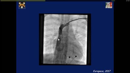 Lead implantation and extraction issues.